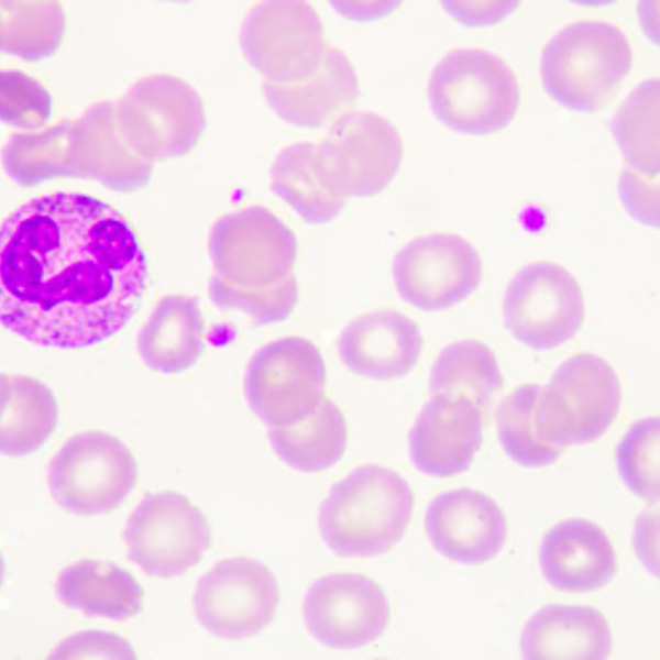 thumbnail of Korkea hemoglobiini